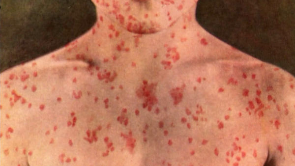 Measles in Khyber Agency