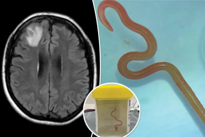 "Parasitic roundworm in human brain"