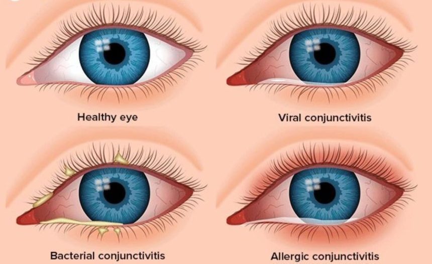 Pink Eye
