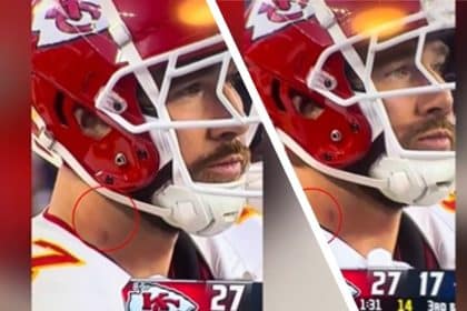 Travis Kelce Neck Mark