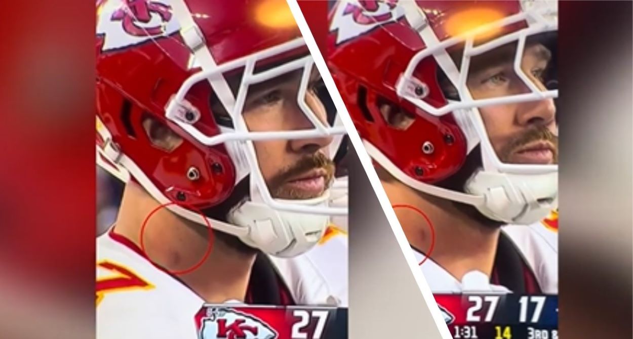 Travis Kelce Neck Mark