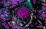 Polyploid giant cancer cells