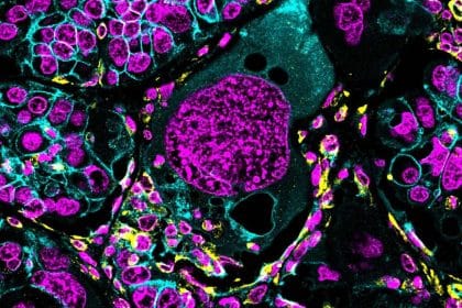 Polyploid giant cancer cells