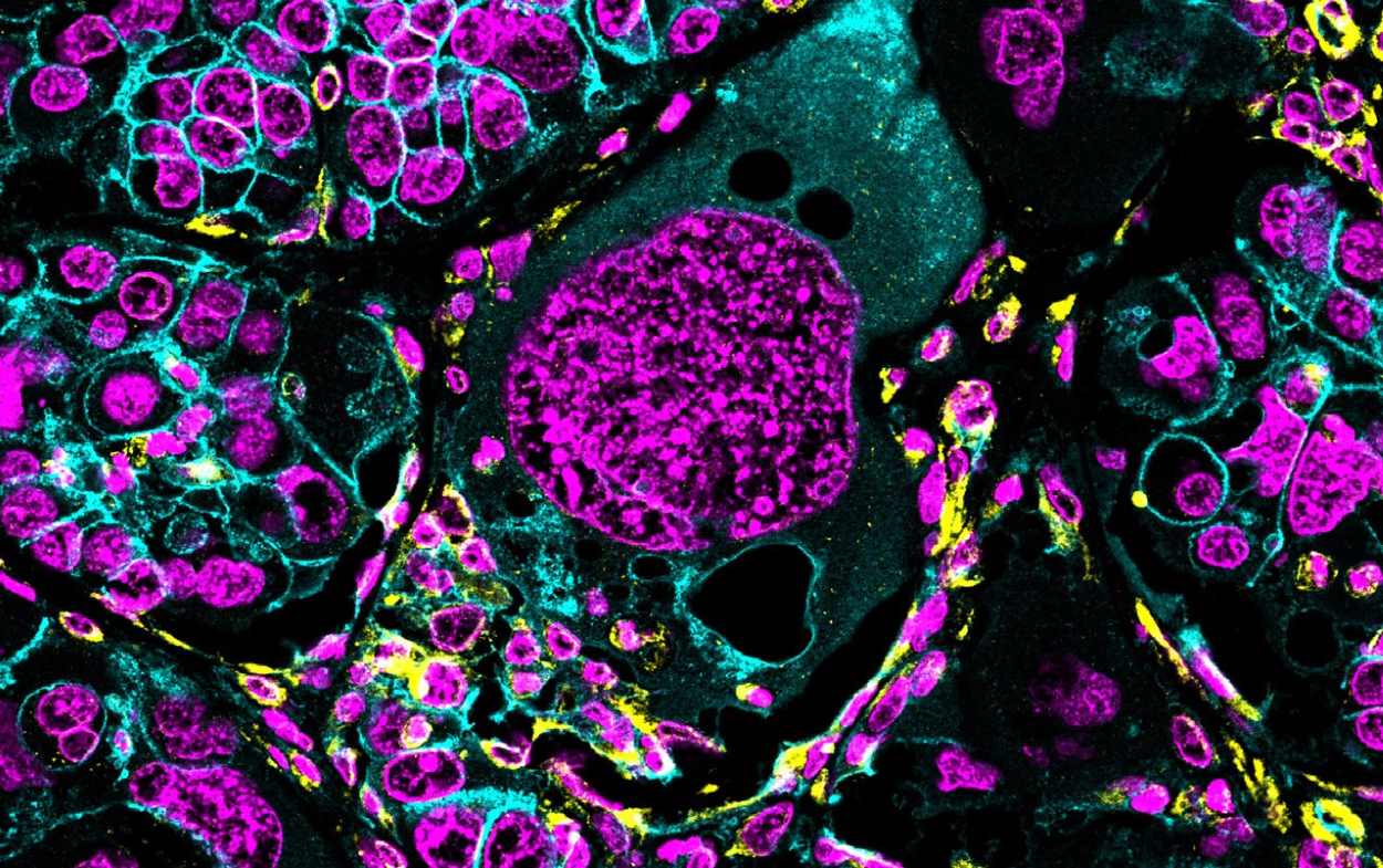 Polyploid giant cancer cells