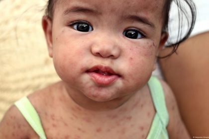 measles outbreak province