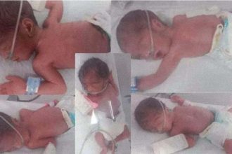 Karachi quintuplets birth 2025