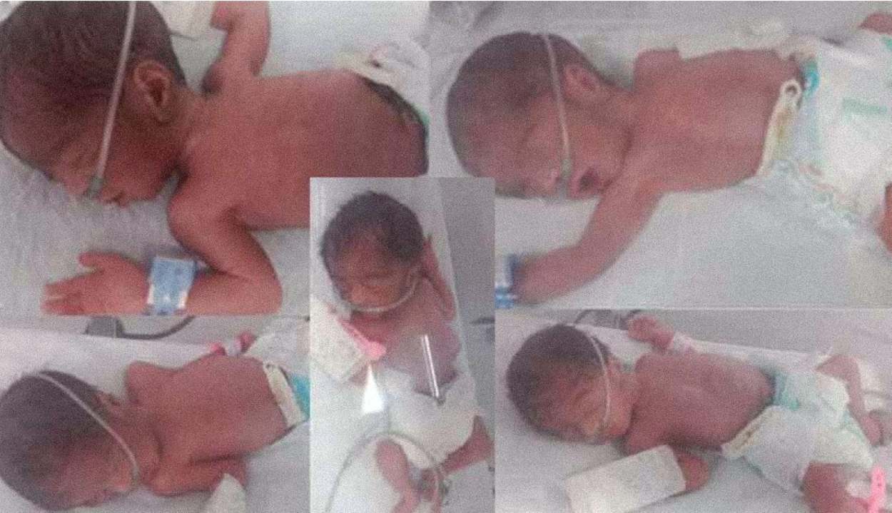 Karachi quintuplets birth 2025