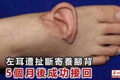 Chinese surgeons ear reattachment foot