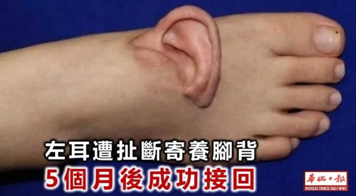 Chinese surgeons ear reattachment foot